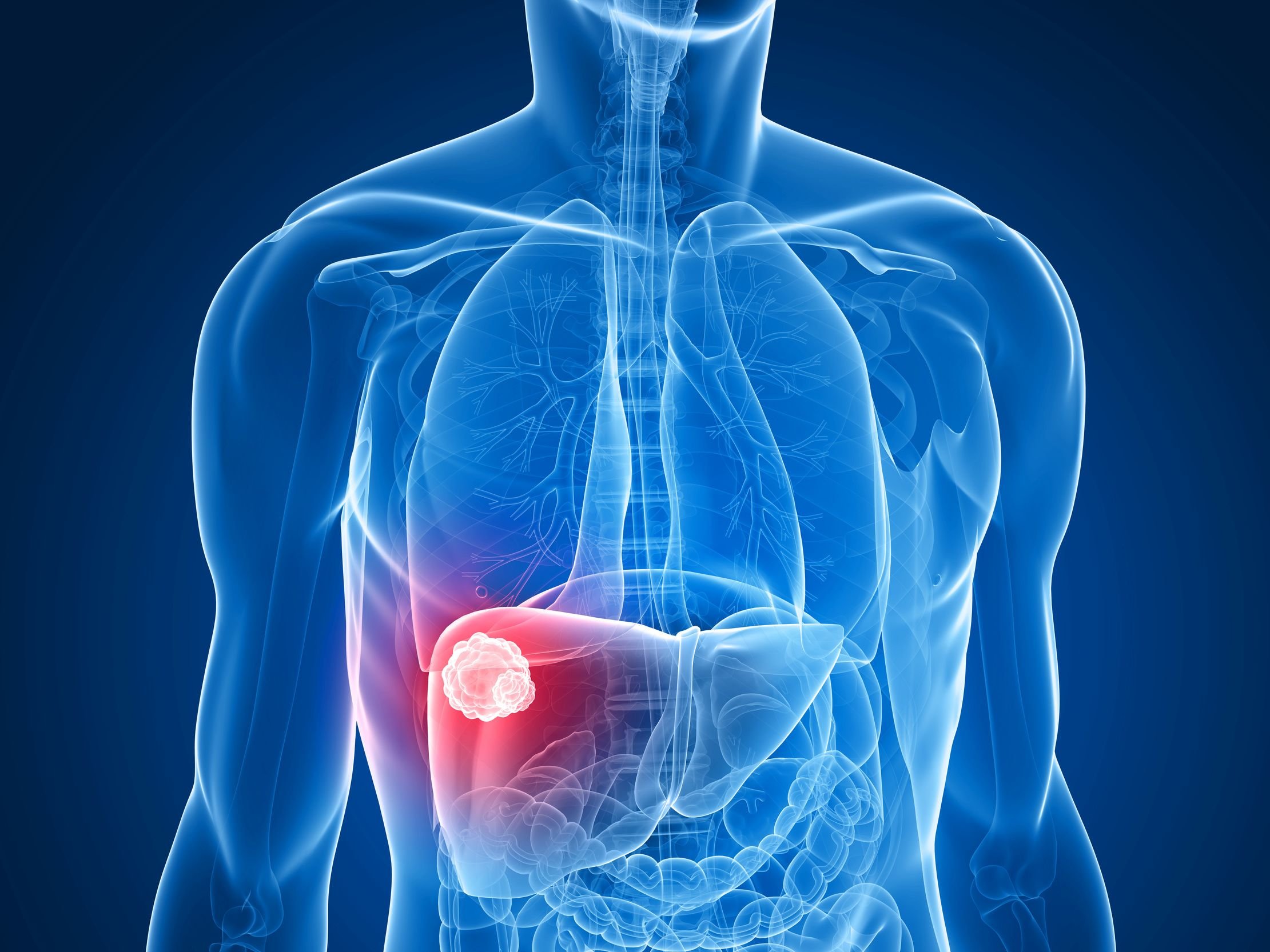 Liver Cancer Cancer Pain India