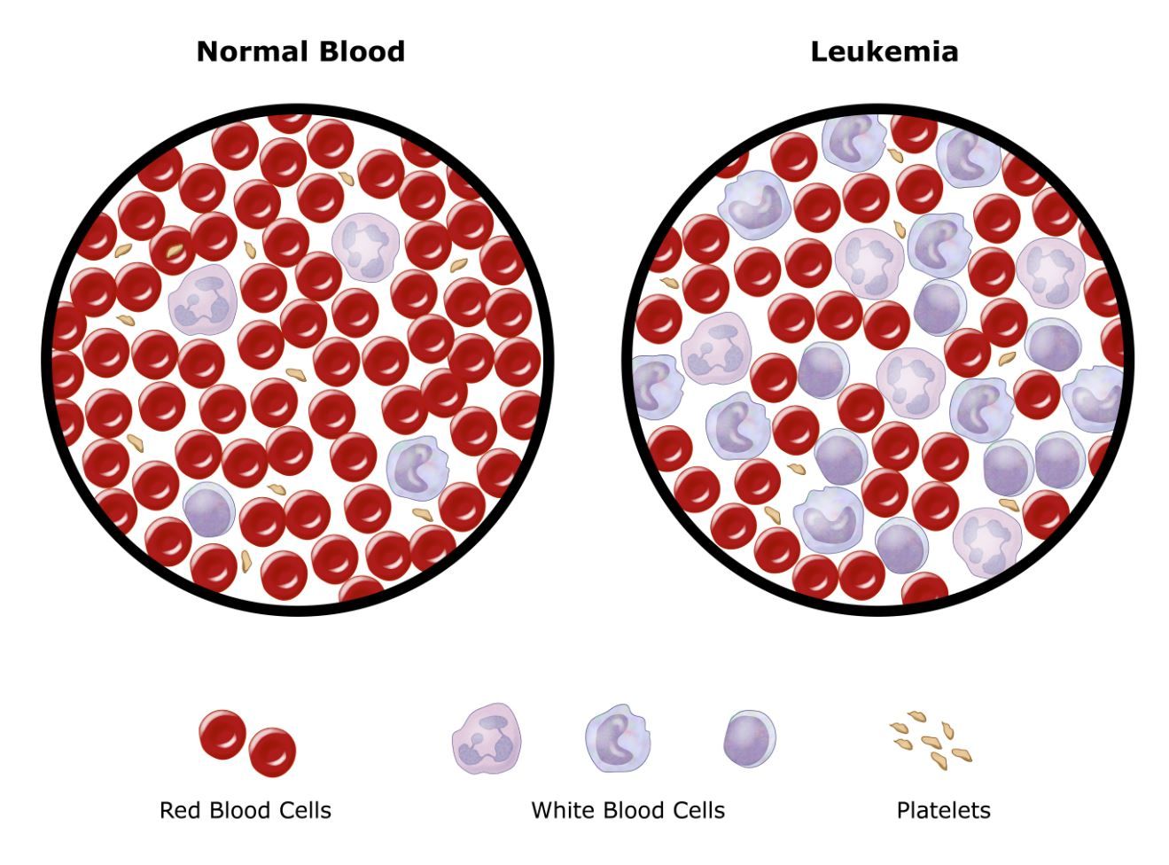 Онкозаболевания крови. Лейкоз клетки крови. Лейкоз и нормальная кровь.