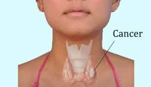 Thyroid Cancer